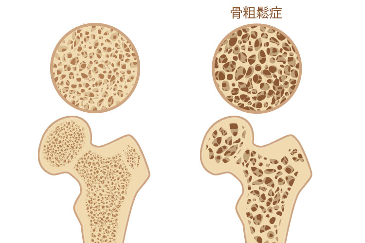 骨粗しょう症