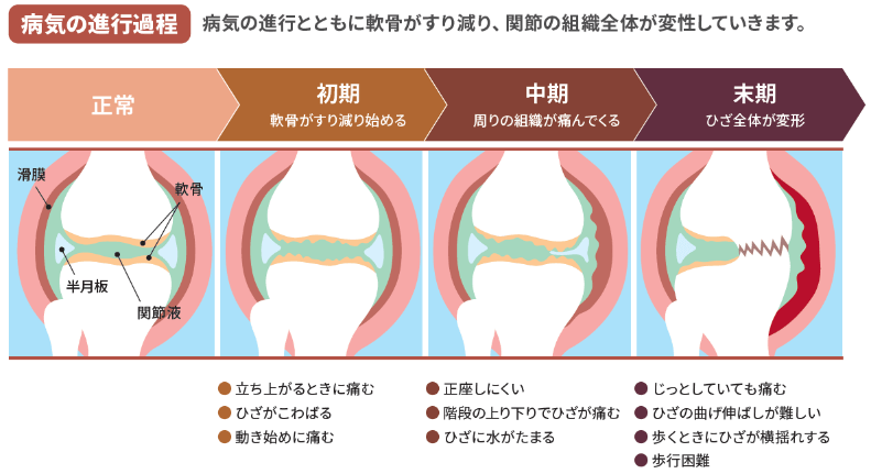 変形性ひざ関節症とは?
